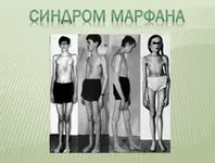 Синдром Марфана.webp